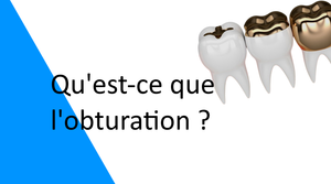 Qu'est-ce que l'obturation dentaire ?